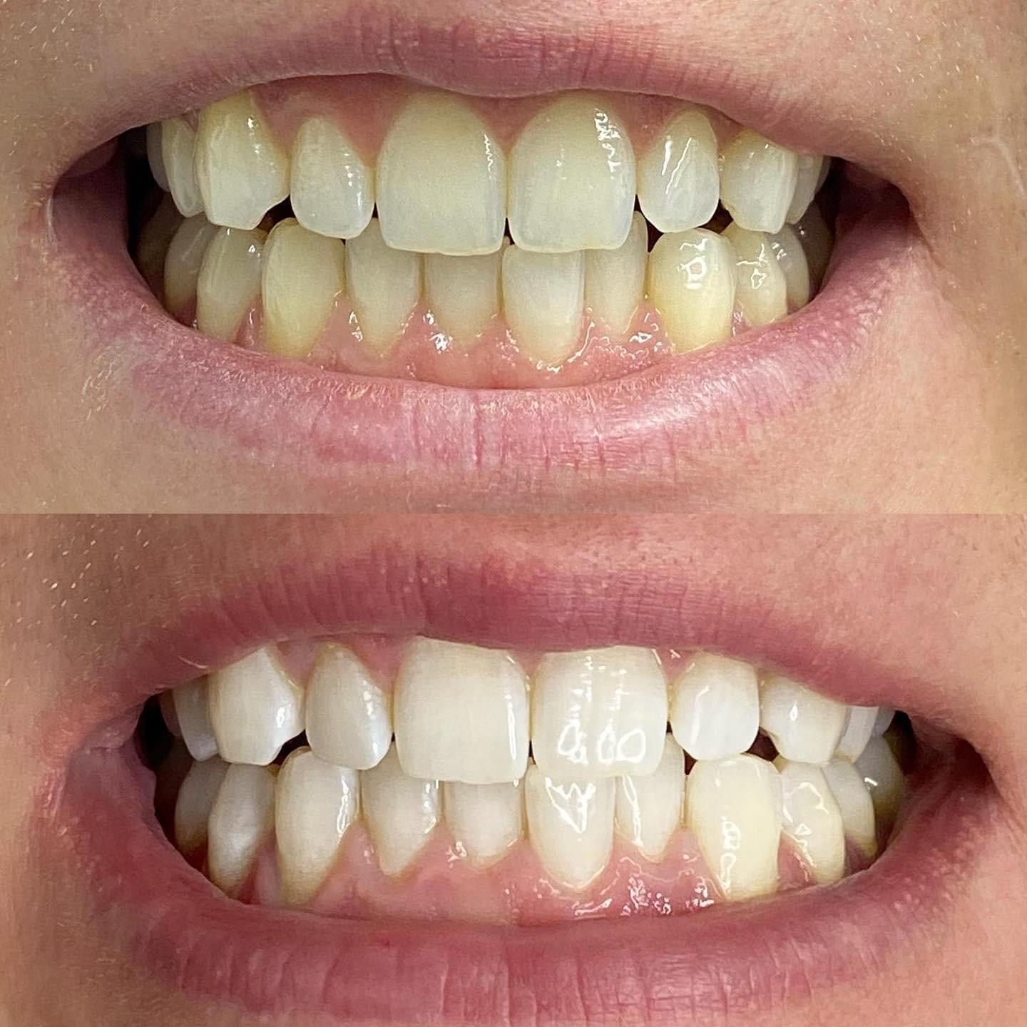 Laser Teeth Whitening Offer From Blink Blink Cardiff