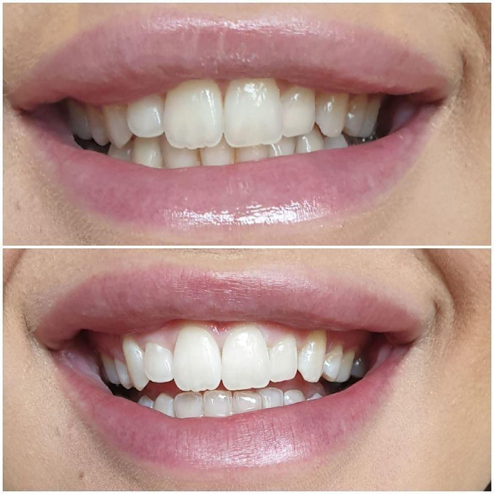 Laser Teeth Whitening Offer From Blink Blink Cardiff